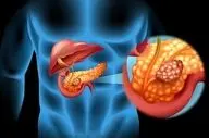 افزایش خطر سرطان پانکراس از طریق میکروب‌های دهانی؛ عامل مخفی را بشناسید 