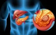 افزایش خطر سرطان پانکراس از طریق میکروب‌های دهانی؛ عامل مخفی را بشناسید 