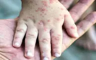 موارد سرخک در این کشور به بالاترین سطح خود در ۳۰ سال گذشته رسید