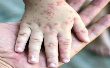 موارد سرخک در این کشور به بالاترین سطح خود در ۳۰ سال گذشته رسید