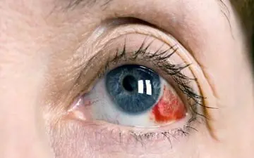 این دارو را نخورید؛ مصرف آن باعث سکته چشمی می‌شود