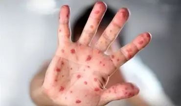 ابتلای ۴۲۲ نفر به سرخک در ۳ ماه اول سال/ شیوع بالاتر بیماری در ۲ استان