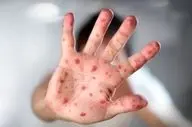 ابتلای ۴۲۲ نفر به سرخک در ۳ ماه اول سال/ شیوع بالاتر بیماری در ۲ استان