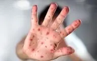 ابتلای ۴۲۲ نفر به سرخک در ۳ ماه اول سال/ شیوع بالاتر بیماری در ۲ استان
