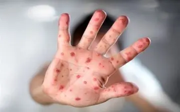 ابتلای ۴۲۲ نفر به سرخک در ۳ ماه اول سال/ شیوع بالاتر بیماری در ۲ استان