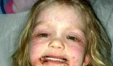  هشدار به والدین/آسیب شدید دختر خردسال بر اثر استفاده از لوازم آرایش+ تصاویر