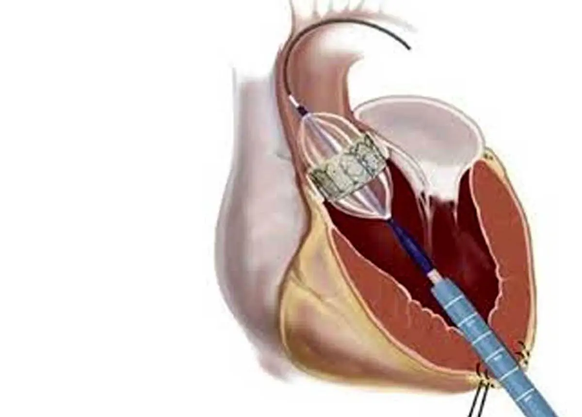 علائم تنگی دریچه آئورت