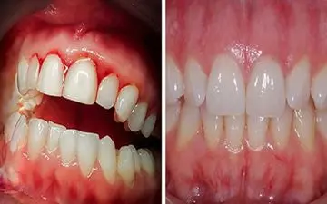 انواع بیماری های لثه از تشخیص تا درمان