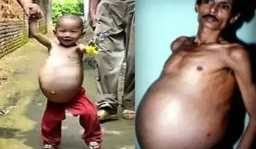  این مرد هندی ۳۶ سال بدون اینکه بداند «باردار» بود