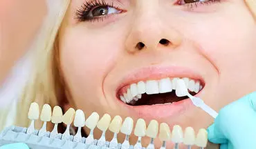 همه چیز درمورد کامپوزیت دندان| طول عمر کامپوزیت دندان چقدر است؟