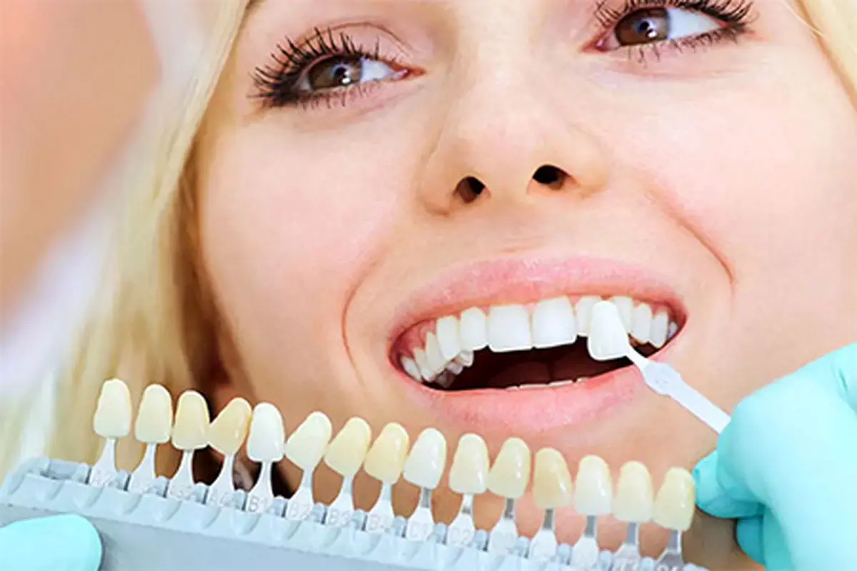 همه چیز درمورد کامپوزیت دندان| طول عمر کامپوزیت دندان چقدر است؟