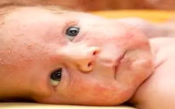 سرخجه؛ تهدیدی جدی برای مادران باردار و نوزادان/ علائم اولیه بیماری سرخجه