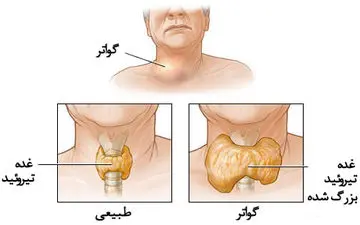 چند نوع گواتر داریم؟