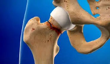 افزایش تراکم استخوان با این راهکار ساده!