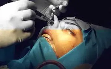 عمل بینی باز برای چه کسانی خطرناک است؟