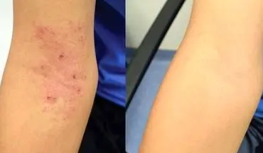 آنچه درباره اگزمای سرشتی نمی دانستید