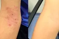 آنچه درباره اگزمای سرشتی نمی دانستید