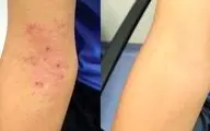 آنچه درباره اگزمای سرشتی نمی دانستید