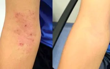 آنچه درباره اگزمای سرشتی نمی دانستید