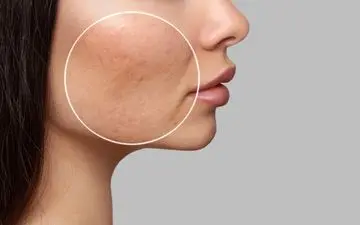 با این ترفندها از شر منافذ باز پوستی راحت شو!| به پوست صاف و زیبا سلام کن