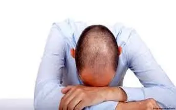 دانشمندان راهی برای درمان طاسی یافتند