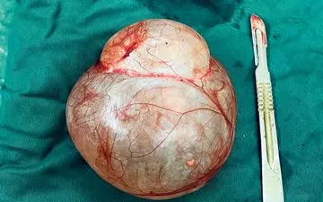 خارج کردن کیست ۳ کیلویی از شکم زن جوان