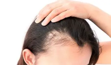 راز جلوگیری از ریزش مو؛ این ویتامین‌ها موهایی قوی و سالم به شما هدیه می‌کنند