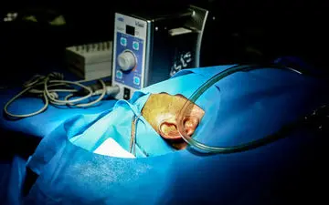 مقایسه کاشت حلزون با سمعک شنوایی/کدام بهتر است!