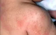 این افراد مستعد سرطان پوست هستند!