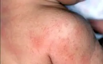 این افراد مستعد سرطان پوست هستند!