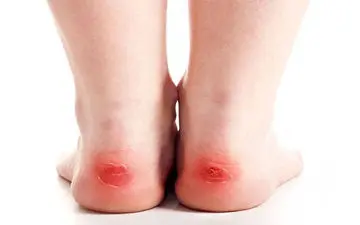 چگونه می شود از تاول زدن پیشگیری کرد؟