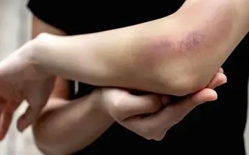 کبود شدن بی‌دلیل پوست بدن علت طبیعی دارد؟