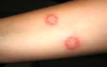  سالک چیست و چطور منتقل می‌شود؟