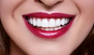 کامپوزیت دندان چیست و چطور انجام میشود؟