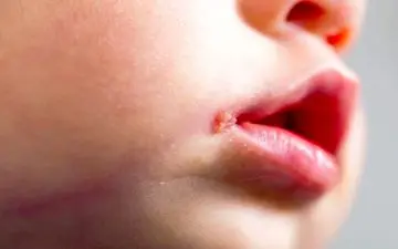 روشی برای درمان برفک دهان