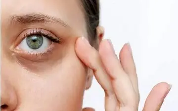 تیرگی دور چشم به چه علت است؟