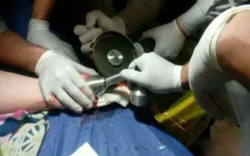 
چرخ گوشت انگشتان دست دختربچه کرمانی را بلعید + عکس تلخ
