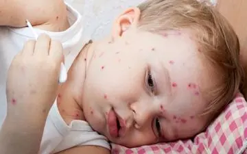 این علائم گویای ابتلا به مخملک است/مخملک هنوز کشنده است؟