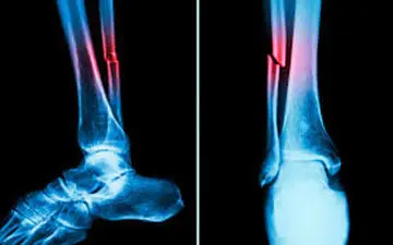 روند التیام جوش خوردگی استخوان را بهبود ببخشید!