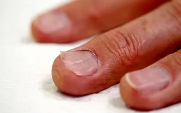 علائم کمبود روی در ناخن ها