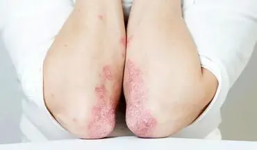 راز کاهش ۳۰ درصدی خطر پسوریازیس تنها در یک عادت سبک زندگی