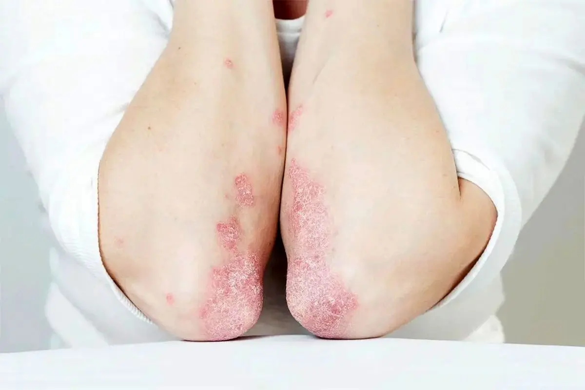 راز کاهش ۳۰ درصدی خطر پسوریازیس تنها در یک عادت سبک زندگی