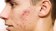 با جای جوش‌ ها چه باید کرد؟