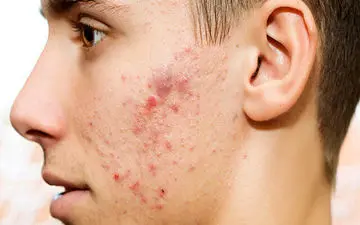 آیا لیزر جای جوش بهترین روش برای درمان این عارضه است؟