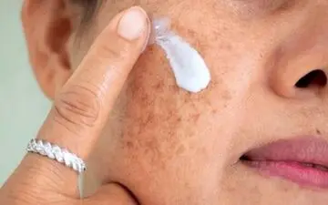 لکه‌های پوستی درمان می شوند؟

