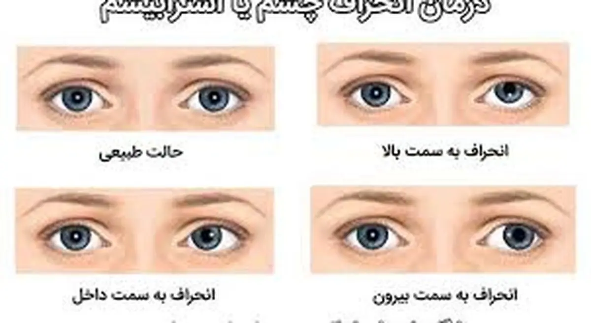 انحراف چشم مخفی و این درمان ها