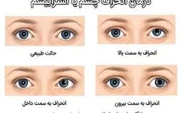 انحراف چشم مخفی و این درمان ها