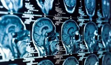 پایان نیاز به جراحی؟ ابداع روشی برای پاکسازی ضایعات سکته مغزی