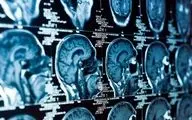 پایان نیاز به جراحی؟ ابداع روشی برای پاکسازی ضایعات سکته مغزی