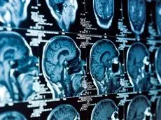 پایان نیاز به جراحی؟ ابداع روشی برای پاکسازی ضایعات سکته مغزی